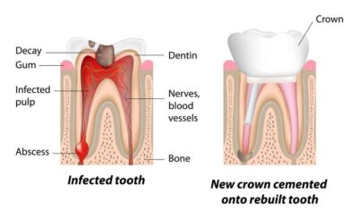 Root Canal Condition