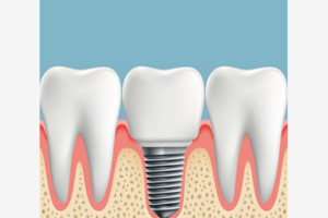 Single Dental Implant Diagram