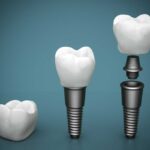 Dental Implant Elements