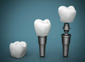 Dental Implant Elements