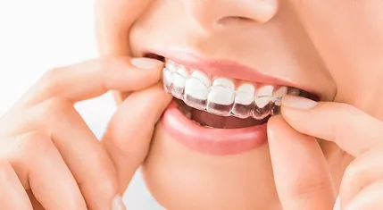 Clear Aligners - Braces