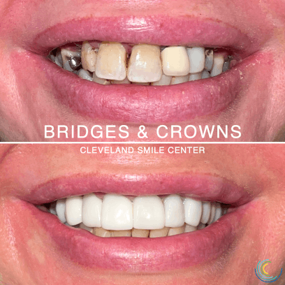 Amy Dental Bridges and Crowns Title