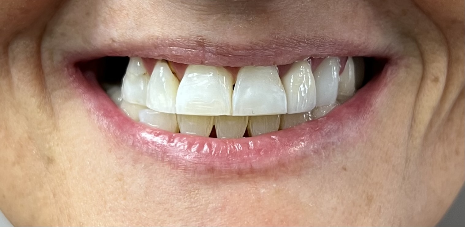 Linda - Veneers - Before - Closeup