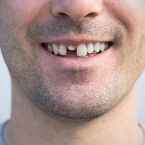 Man with Chipped Front Tooth