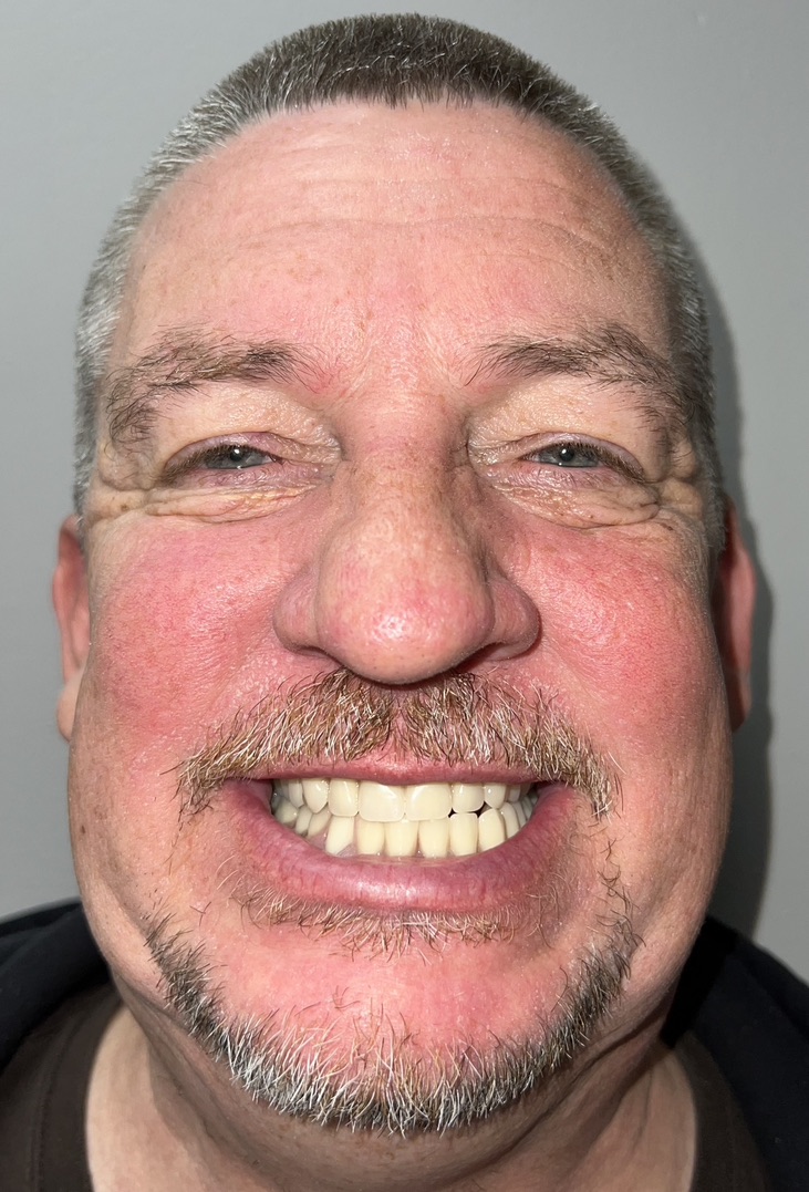 Rob After Snap-On Implant Dentures