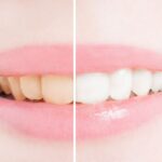 Before and After Whitening