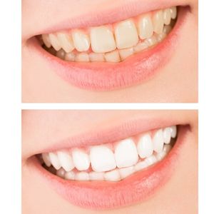 Whitening -before and after