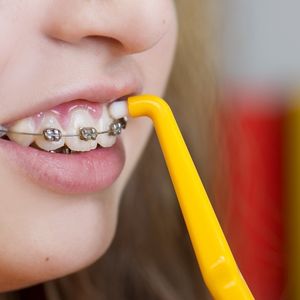 Child cleaning teeth around braces