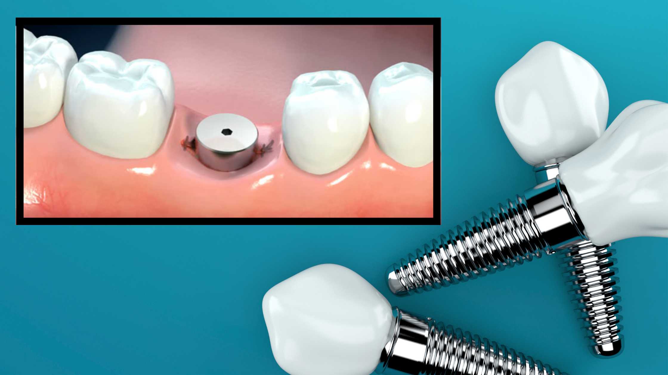 What Is An Implant Healing Cap Cleveland Smile Center 