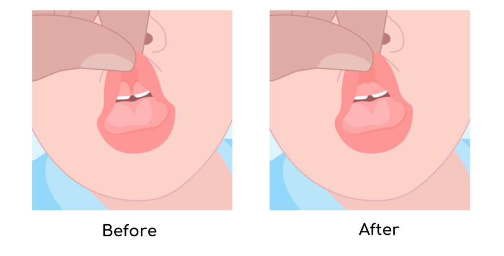 Lip Tie Before and After