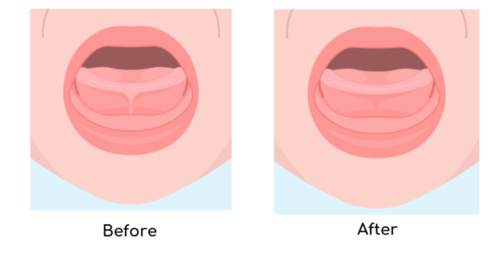Tongue Tie Before and After