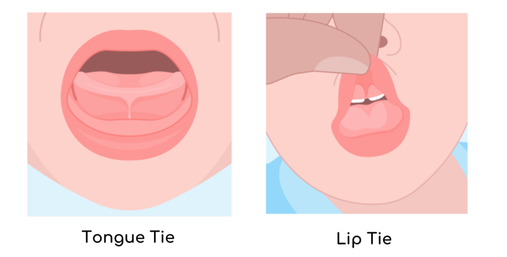 Tongue Tie and Lip Tie