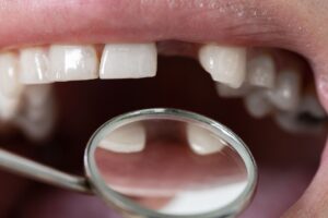 Restorative Dentistry General - Missing Tooth