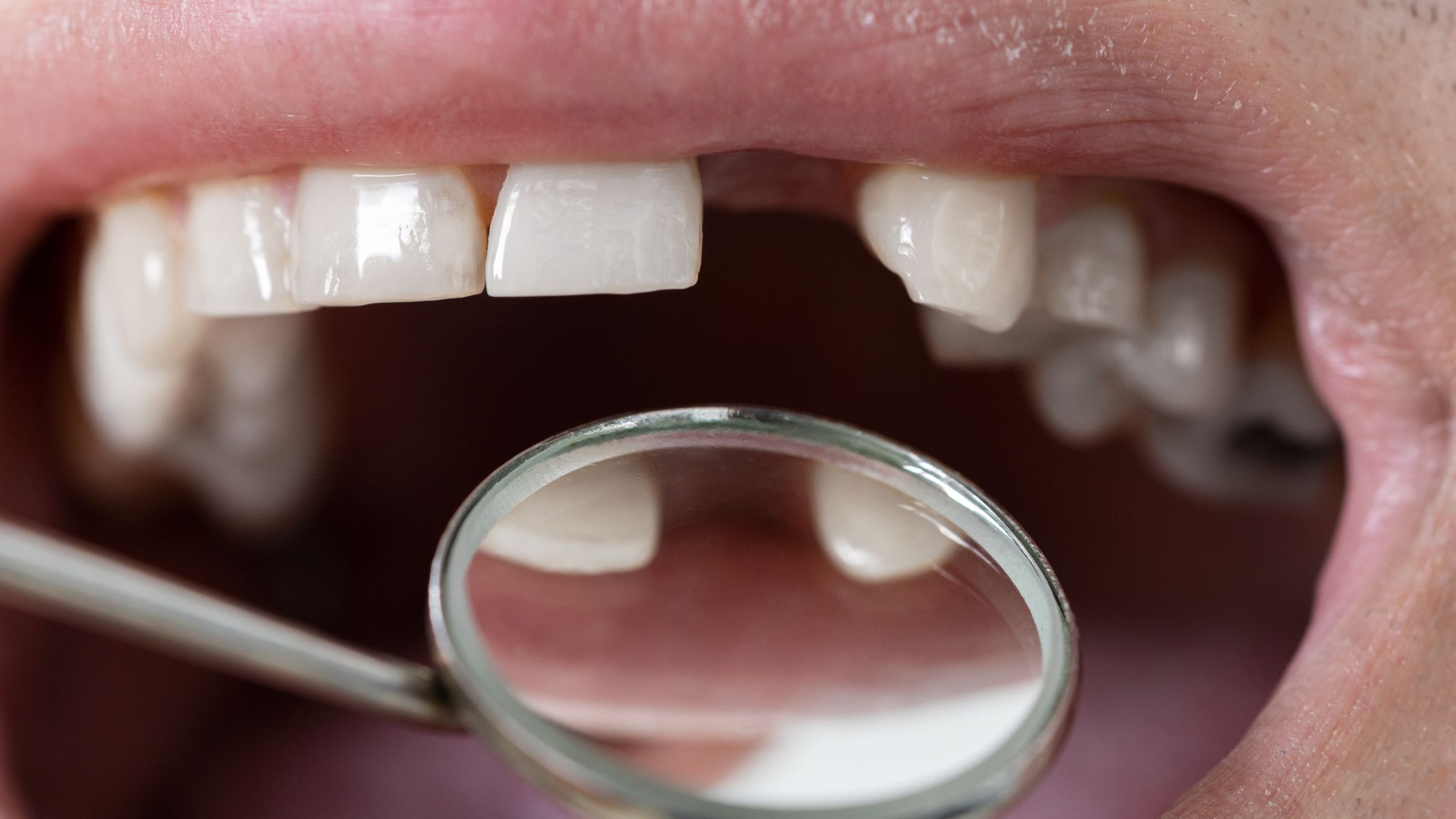 Restorative Dentistry General - Missing Tooth