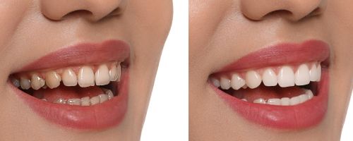 Veneers - Before and After