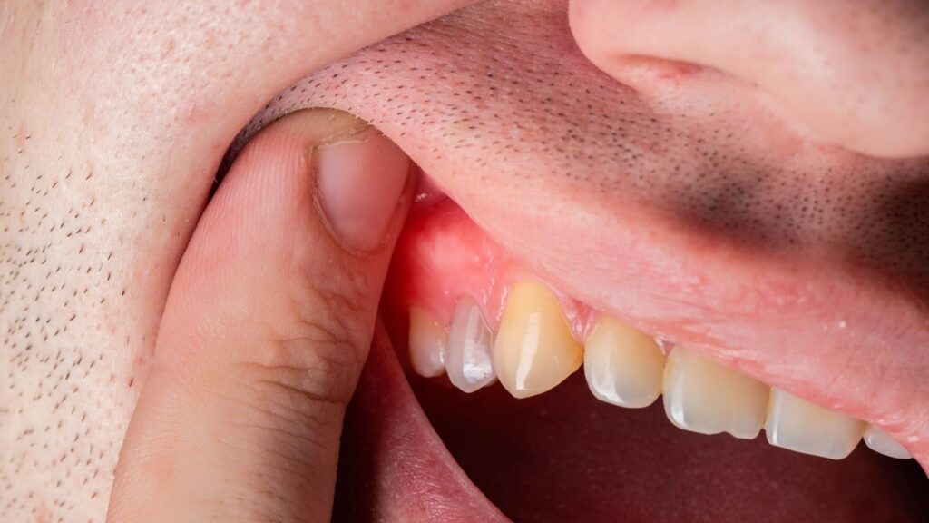 Red Gums - Dental Infection
