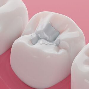 Composite Dental Filling