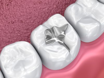 Mercury Dental Filing