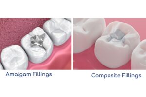 amalgam fillings or composite fillings