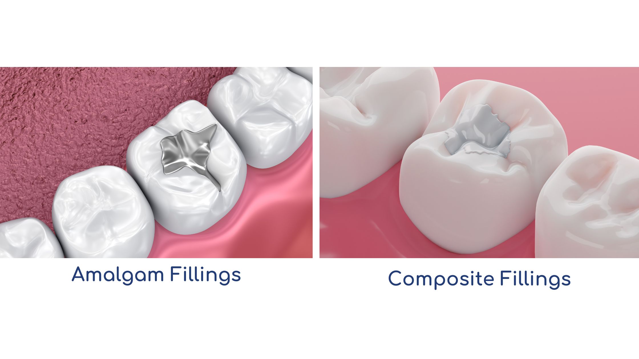 amalgam fillings or composite fillings