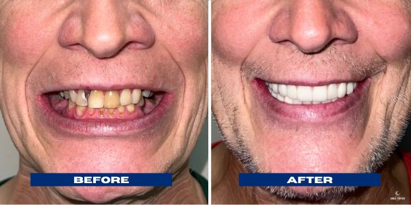 Jeff All On 4 Implants