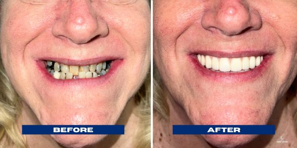 Leanne All On 4 Implants