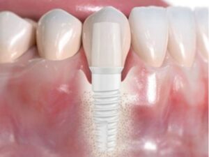 Zirconia Ceramic Dental Implants Jaw Zirconia Ceramic Dental Implants in Jaw