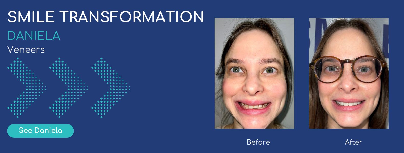 Daniela - Veneers-Smile-Transformation