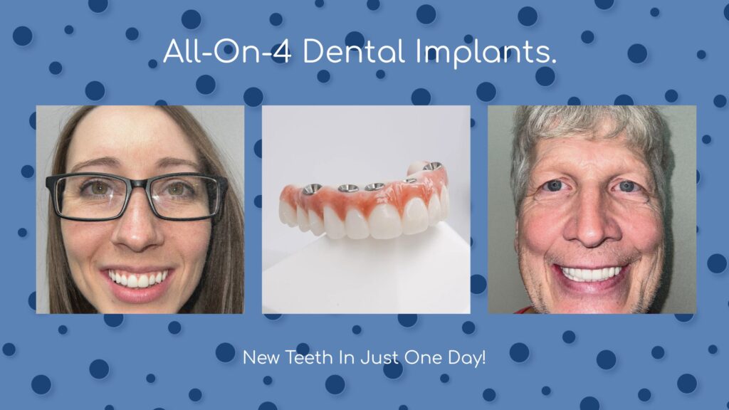 All-On-4 Dental Implants. New Teeth In Just One Day