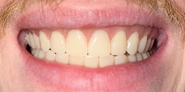 Colin Full Smile After Dentures