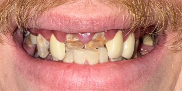 Colin Full Smile Before Dentures