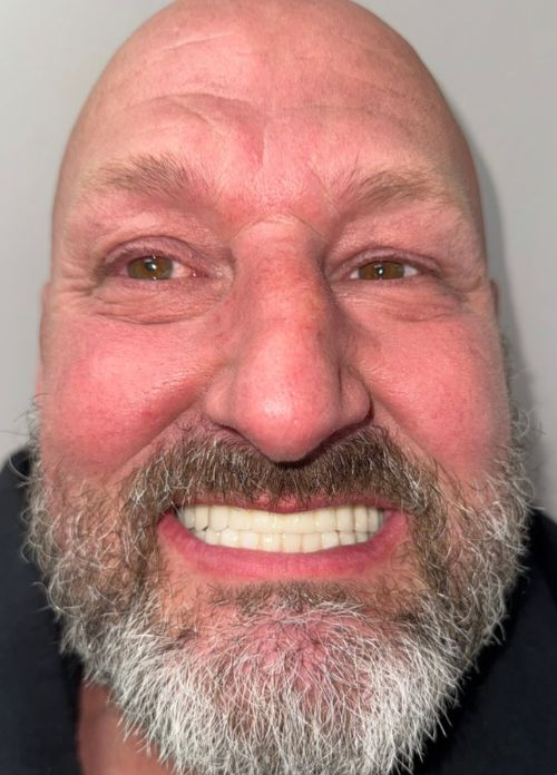 Todd All On 4 Full Mouth Implants After Todd All On 4 Full Mouth Implants After