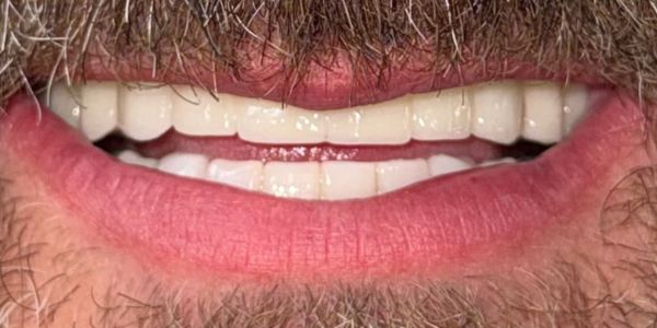 ToddFull Smile After All-On-4 Full Mouth Implants