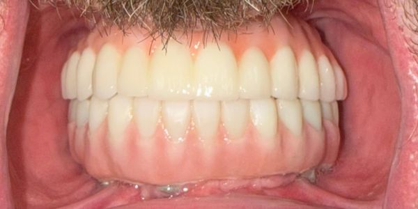 Todd AllOn4 - After - Retracted Todd AllOn4 - After - Retracted