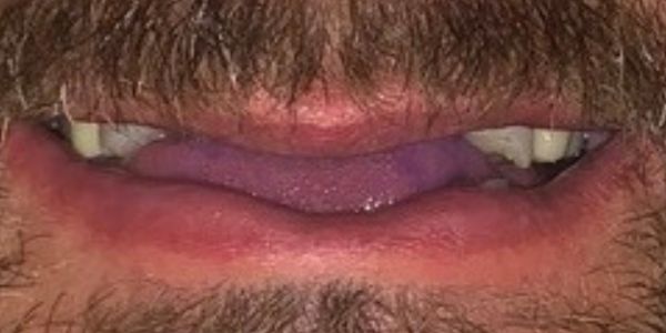 Todd Full Smile Before All-On-4 Full Mouth Implants