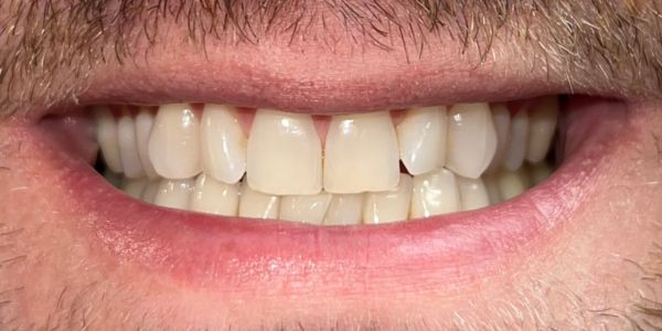 Gavin Invisible Aligners - Before - Mouth Gavin Invisible Aligners - Before - Mouth