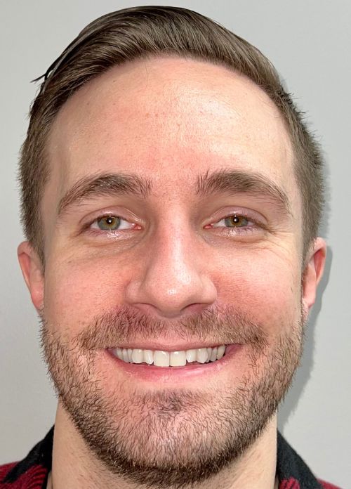 Gavin Invisible Aligners - Before Gavin Invisible Clear Aligners Full Face - Before