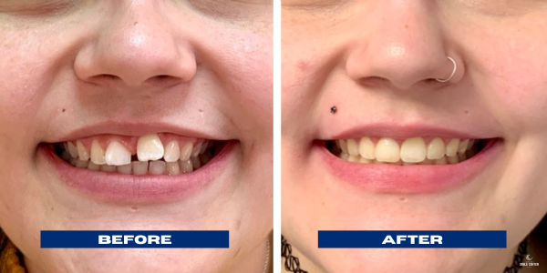 Breanna Clear Aligners