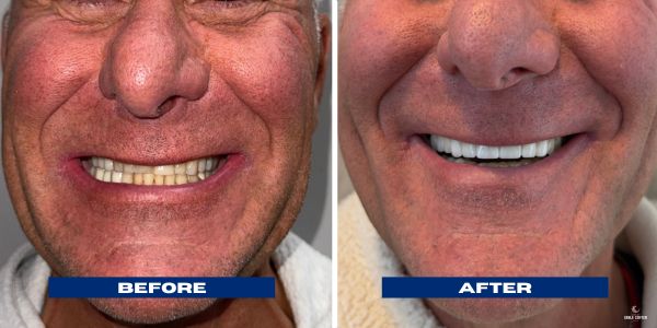 Dan Porcelain Veneers