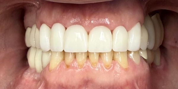 Dr. Dan Porcelain Veneers - After - Retracted Dr. Dan Porcelain Veneers - After - Retracted