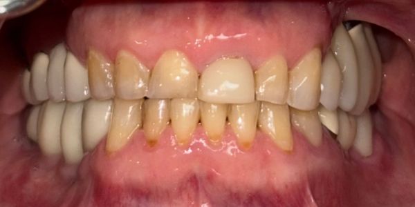 Dr. Dan Porcelain Veneers - Before - Retracted Dr. Dan Porcelain Veneers - Before - Retracted