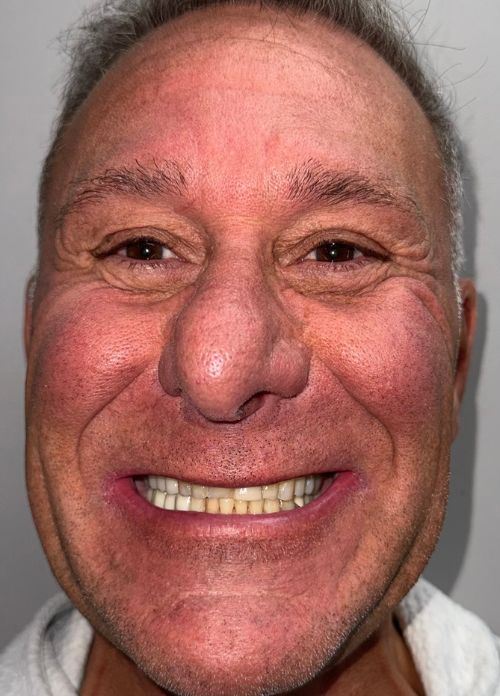 Dr. Dan Porcelain Veneers - Before Dr. Dan Porcelain Veneers - Before