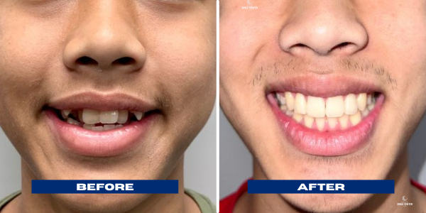 Neehan Traditional Braces