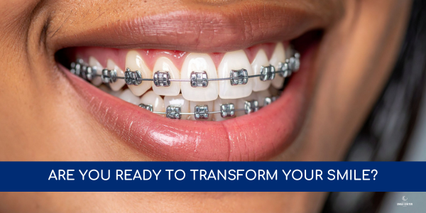 Traditional Metal Braces