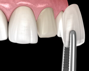 Veneer installation procedure