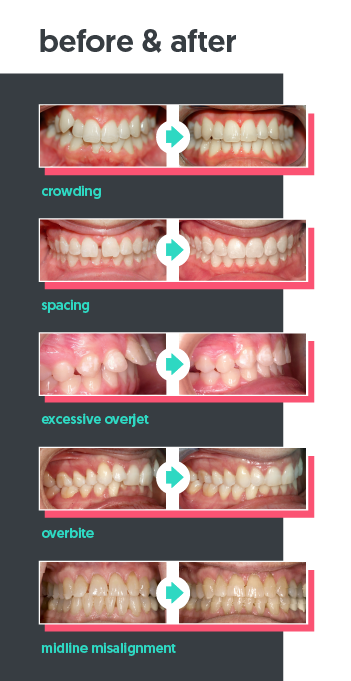 orthodontics-alignment-issue-types-cropped orthodontics alignment issue types