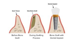 Bone Graft Header
