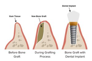 Bone Graft Header