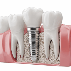 Bone Grafting - Implant Placed