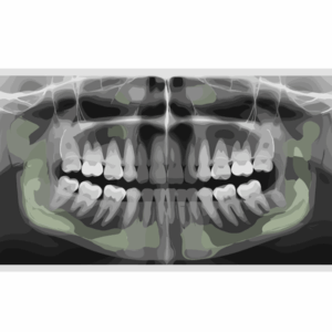 Bone Grafting - xray bone structure